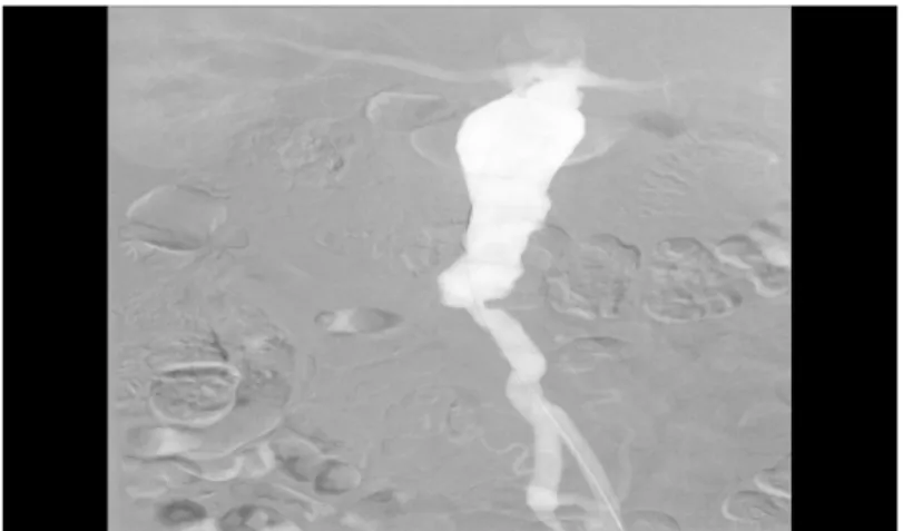 Şekil 1: Tek taraflı iliak arter stenozu olan hastanın DSA görünütüsü . 