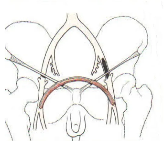 Şekil 5: Obturator bypass