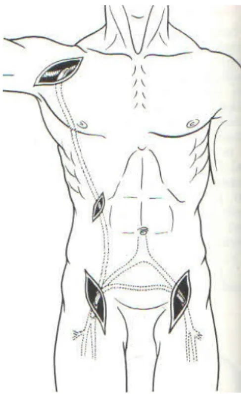 Şekil 7: Aksillo-bifemoral bypass