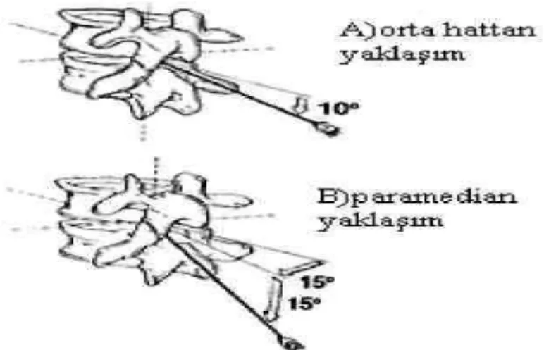 Şekil 12: Spinal Anestezi Yaklaşımları (37) 