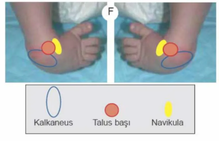 Şekil 9. Talusun Lokalizasyonu(24). 