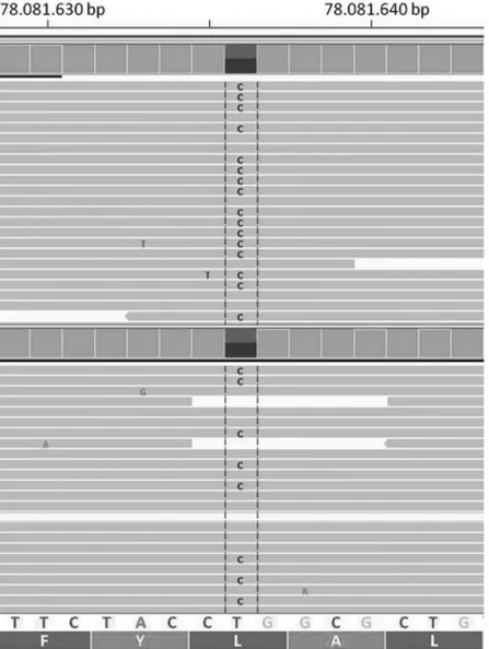Figure 2.  Result  of  the  GAA  gene  sequencing  encompassing  the  c.896  T&gt;C. The pictures at the top and  bot-tom  are  belong  to  mother  and  father  respectively