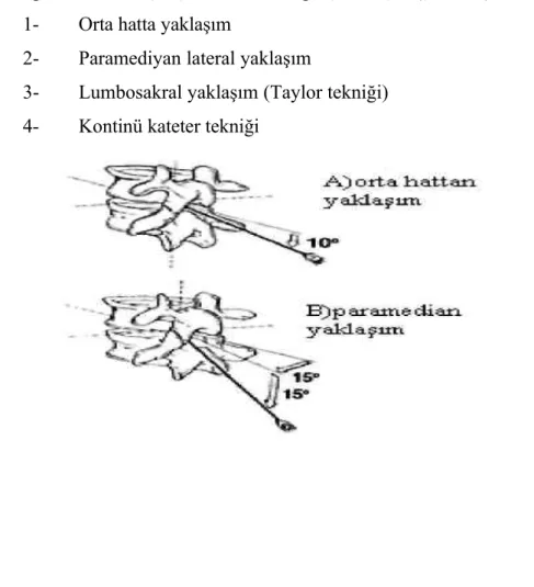 Şekil 12: Spinal Anestezi Yaklaşımları (62)