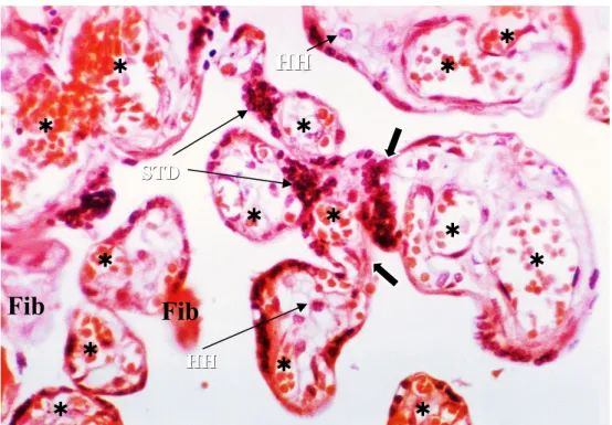 Şekil 3: Preeklamptik plasenta görünümü. Genel olarak villuslarda sinsityal düğüm artışı (STD), köprüleşmeler (oklar), fetal kapiller sayı ve volümünde artış (yıldızlar), Hofbauer   hücreleri   (HH)   ve   fibrinoid   (Fib)   artışı   izlenmektedir   (H-E,