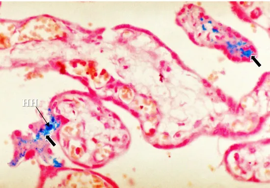 Şekil 6: Kontrol plasenta fetal periferik kesiti. Normal villuslarda demir birikimleri subtrofoblastik alanda granüler, lineer (kalın oklar) ve Hofbauer hücrelerinde parlak mavi renkte gözleniyor
