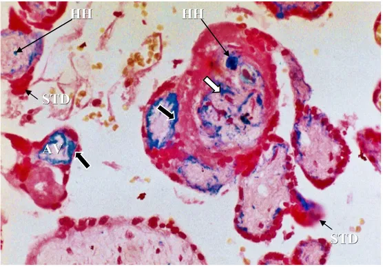 Şekil   7:  Preeklamptik   plasenta   fetal   santral   kesiti.   Anormal   villusların subtrofoblastik   alanında   (siyah,   kalın   oklar),   Hofbauer   hücrelerinde   ve   villus stromasında (beyaz ok) parlak mavi renkte izlenen demir birikimleri