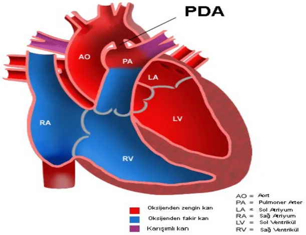 Şekil 1: Patent Duktus Arteriozus