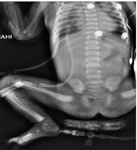 Şekil 4. Bir Özefagus atrezisi hastasının tek taraflı 2 adet göğüs kateteri,  nazojejunal beslenme tüpü ve santral venöz kateteri görülmektedir.
