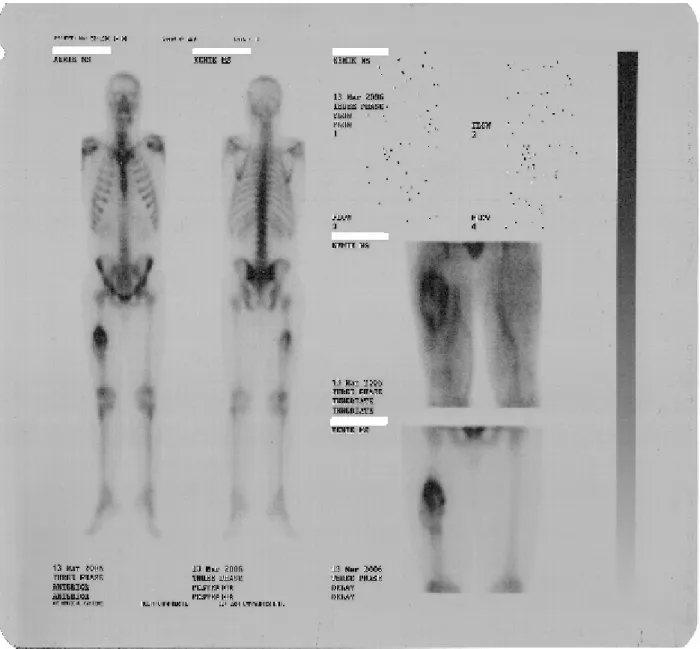 Şekil 3: 29  yaşında kolon adenokanserli erkek  hastanın kemik sintigrafisi. 2  yıl önce kolon  adenokanser  nedeniyle  opere  olan  hasta  bacağında  ağrı  ve  şişlik  şikayetiyle  ortopedi  polikliniğine  başvuruyor.Hastanın  rutin tetkiklerinden  serum 