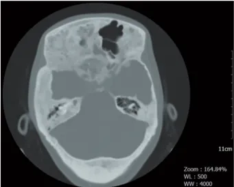 Figure 2. Pituitary computed tomography shows; dense 