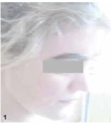 Figure 1. Decreased pigmentation in hair and skin. 