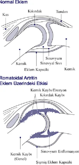 Şekil 2. 1. RA tarafından eklem bozulması  28