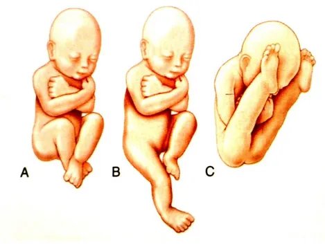 Şekil 1: Prenatal pozisyonlar. 