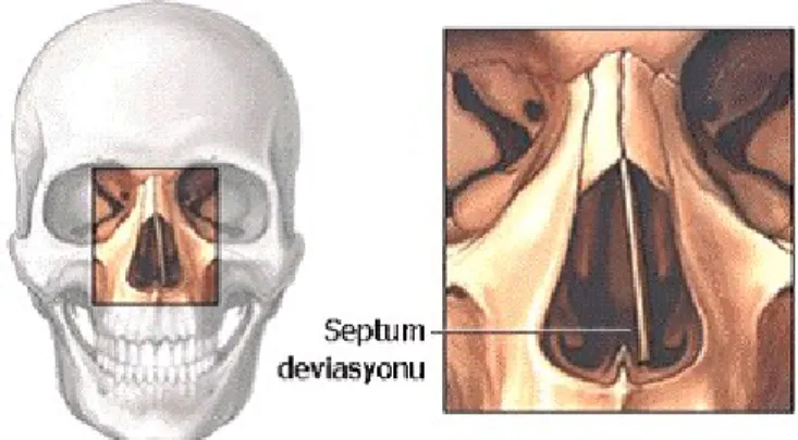 Şekil 5: Septum deviasyonu