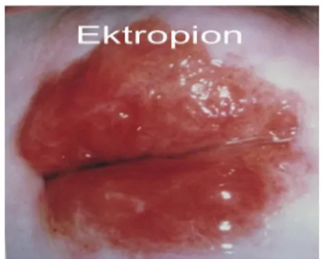 Şekil 8 : Ektropion B. SERVİKSİN PREMALİGN LEZYONLARI