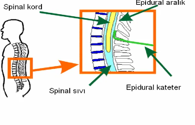 Şekil 11:Epidural ve spinal aralık 
