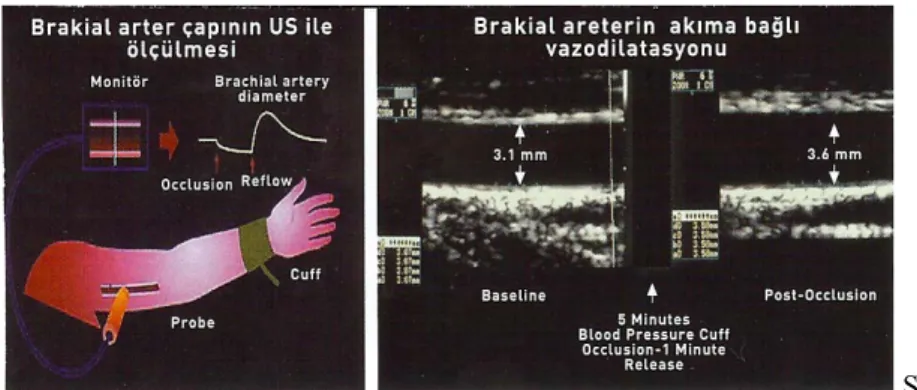 Şekil - 7: Brakiyal arter FMD  İşlem sırasında önce istirahat halindeki brakiyal arter çapı ve akım hızı değerlendirilir