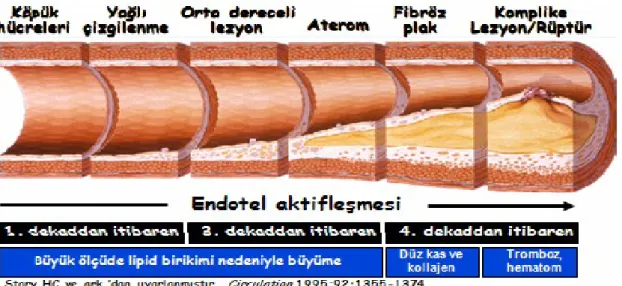 Şekil 2:  Ateroskleroz Gelişimi. Duyarlı plağın rüptürü (%75) veya erozyonu (%25) sonucu akut koroner sendrom gelişir