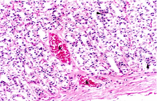 Şekil 9. Ülser Grubu; sıçan mide mukozasında kapiller hemoraji ve iltihabi hücre  infiltrasyonu izlenmektedir