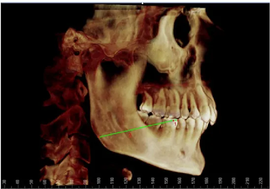 Şekil 4. 1: Anteroposterior molar farkı, 2: Mandibular molar pozisyonu.