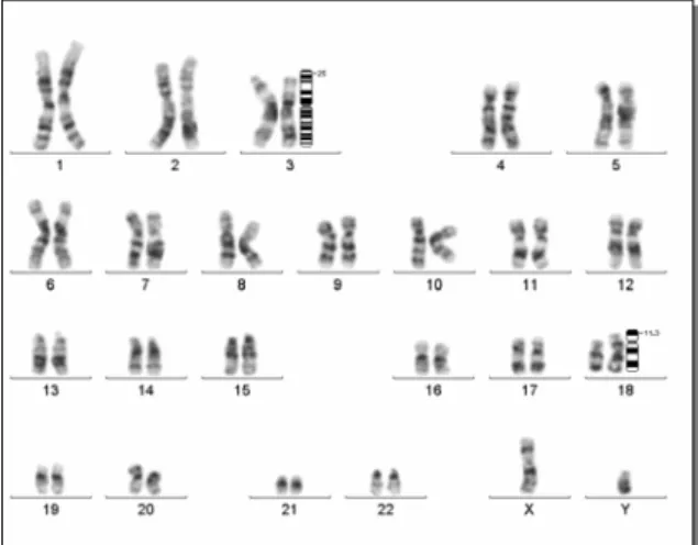 Şekil 1. 46,XY,t(3;18)(p25;p11.3) resiprokal  tipi dengeli translokasyon taşıyıcısı olguya ait  karyotip