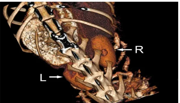Figure 3. Anterior plan image with 3D Reconstructive. W: Width, between the margo lateralis and margo  medialis