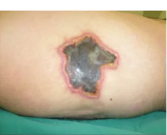 Figure  2.  Early  postoperative  appearance  of  the  case.