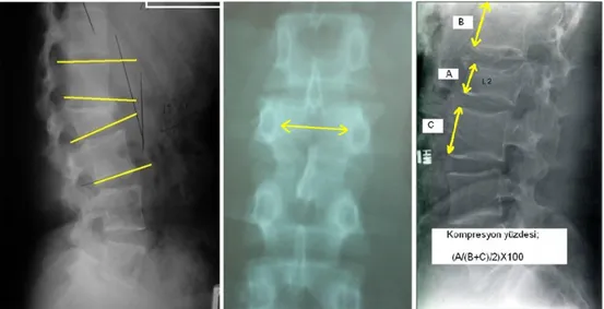 Şekil 11. a) Lateral grafide kifoz açısı ölçümü b) AP grafide pediküller arası  mesafede artış c) Lateral grafide kompresyon miktarı