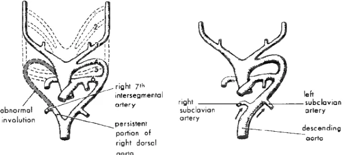 Şekil -4: Aberran sağ subklavyan arterin embriyolojik temeli. 