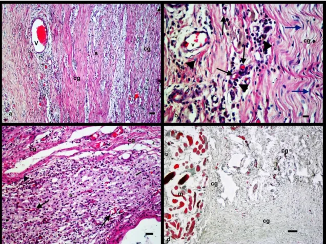 Figure  3:  Histopathologic  view  of  the  tumour,  (a,  b,  c:  H&amp;E,  d:  Mallory’s  triple  stainning),  a:  (Bar=100µm), b: (Bar=25µm), c: (Bar=50µm); s: stroma, cg: collagen fibrils, v: blood vessel, black arrow:  neovascular vessels, blue arrow: 