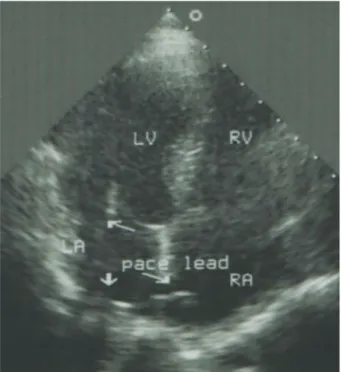 Figure 2. Anteroposterior chest X-ray shows a malposi-