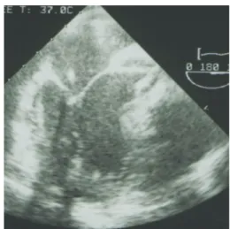 Figure 3B.  Transesophageal  echocardiography  shows 