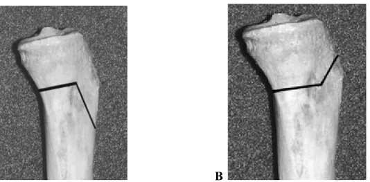 Şekil 28:  A, Tibial  tüberkülün  proksimal  fragmanda  bırakıldığı  iki planlı  osteotomi  şekli (retrotüberkül   osteotomisi)