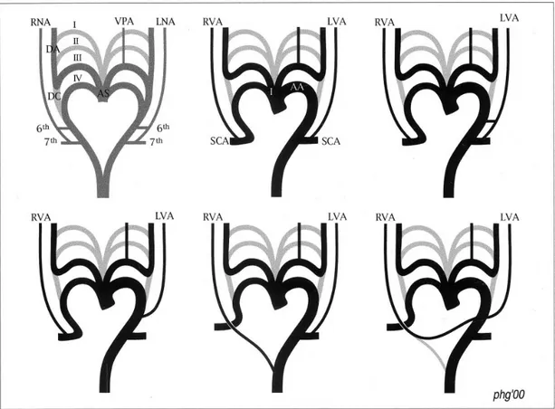 Şekil   9:  Vertebral   arter   anatomisi-orjin   varyasyonları   ve   muhtemel   embriyolojik mekanizmalar şematik olarak gösterilmiştir (16)