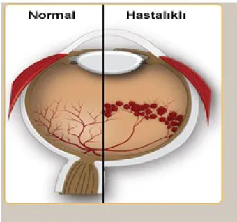 Şekil 2. Prematüre Retinopatisi