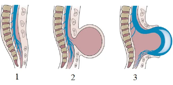 Şekil  7.  Spina  bifida  türleri;  Spina  bifida  okülta(1),  Meningosel(2),  Meningomiyelosel(3),                       Nature Reviews | Disease Primers Volume 1 | 2015 