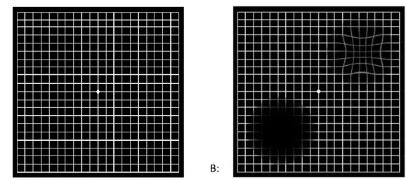 Şekil 3: Amsler Grid A: Normal Amsler Grid B: YBMD‟de görülen distorsiyon ve skotom. 