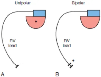 Şekil 2. A: Unipolar pacing devresi, intrakardiyak katod, sağ ventrikül (RV) içinde 