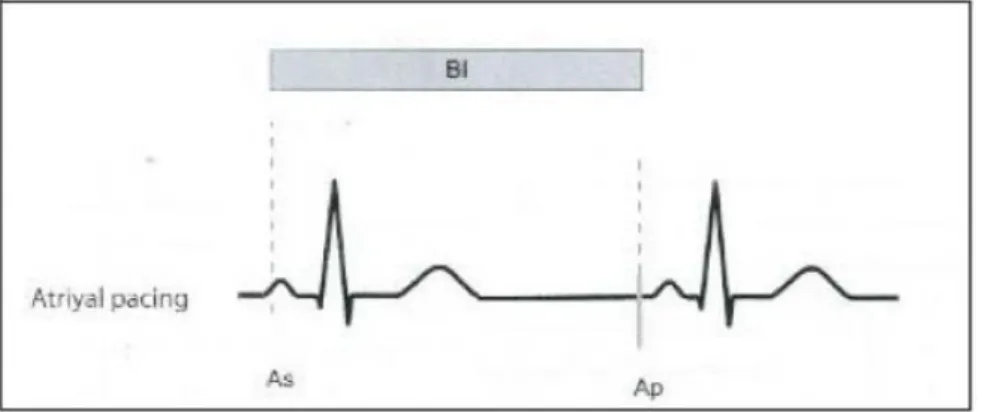 Şekil 7: Tek odacıklı atriyal pacing 