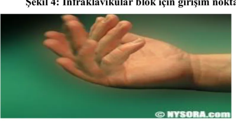 Şekil 5. Kas kontraksiyonu (www.nysora.com) 