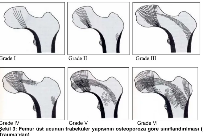 Şekil 3: Femur üst ucunun trabeküler yapısının osteoporoza göre sınıflandırılması (Skeletal Trauma’dan)