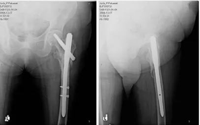 Şekil 8 – 9: Ameliyat sonrası 3.aydaki sol kalça femur dahil AP ve frogleg grafiler.