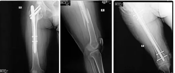 Şekil 5 – 6 - 7: Ameliyat sonrası 20. aydaki merdivenden düşme sonrası sağ  femur  AP ve sağ diz femur dahil lateral grafiler