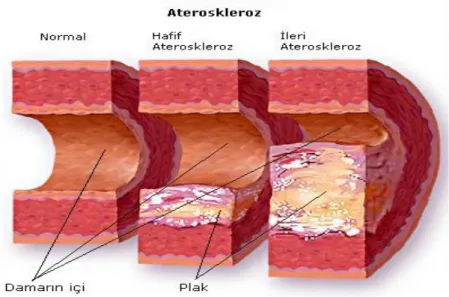 Şekil - 1: Ateroskleroz aşamaları 