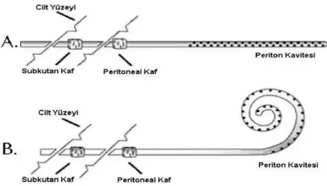 Şekil 7: Çift kaflı Tenckhoff periton kateterleri: standart (A), kıvrık (B) 