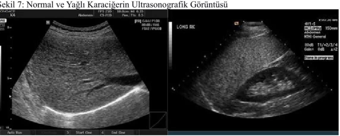 Tablo 3: Hepatostetozun Ultrasonografik Derecelendirilmesi
