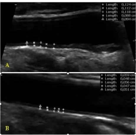 Şekil 3: Karotis intima mediya kalınlığı  ölçümü ( A: Kalınlaşmış intima 