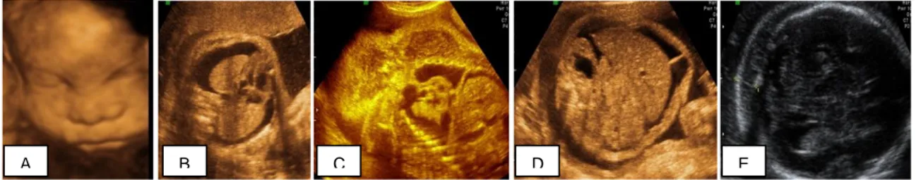 Şekil    2:  Hidropik  fetus  USG  görüntüsü.  A:  Fasyal  ödemin  üç  boyutlu  USG 