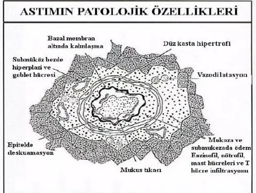 Şekil  2.4.  Astım  hastalarının  hava  yollarında  oluşan  patolojik  değişiklikler 