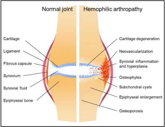 Şekil 2.2. Normal eklem ve hemofilik artropatili eklem (50) 